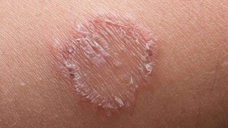 5 Effective ways to cure ringworm naturally
