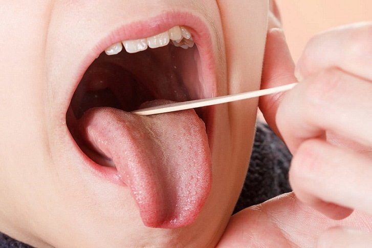 What is Tonsillitis and How Can You treat it?
